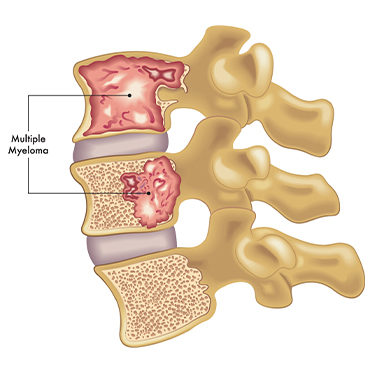 What Is Multiple Myeloma? Understanding Symptoms And Treatment Options